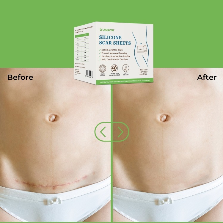 Trusavor Silicone Scar Sheets - Image 7